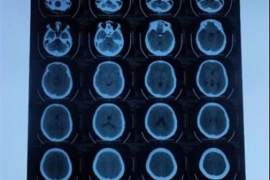 醫用CT膠片-激光藍基膠片